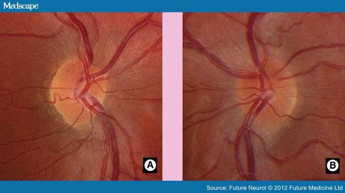Normal Retina vs. Papilledema - Trial Exhibits Inc.