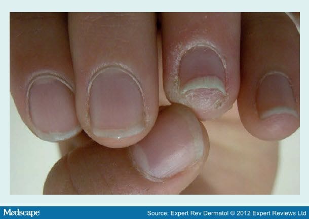 acrylic nail fungus