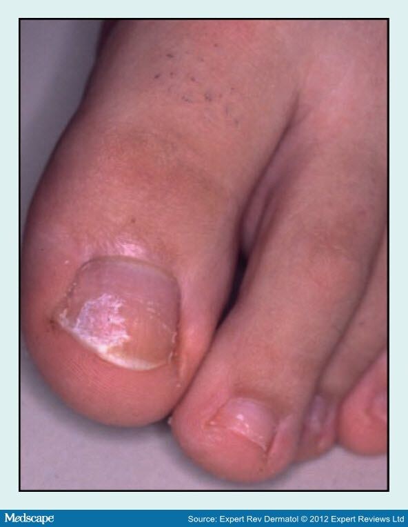Onychomycosis in Children