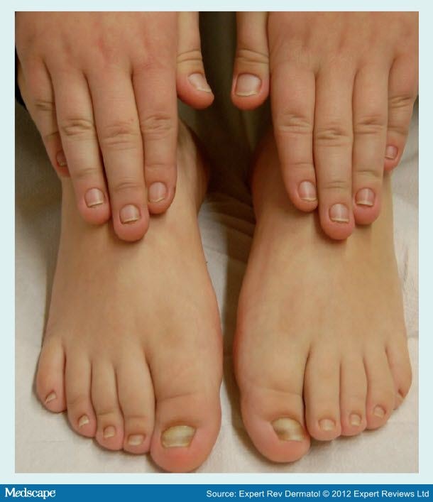 Onychomycosis in Children