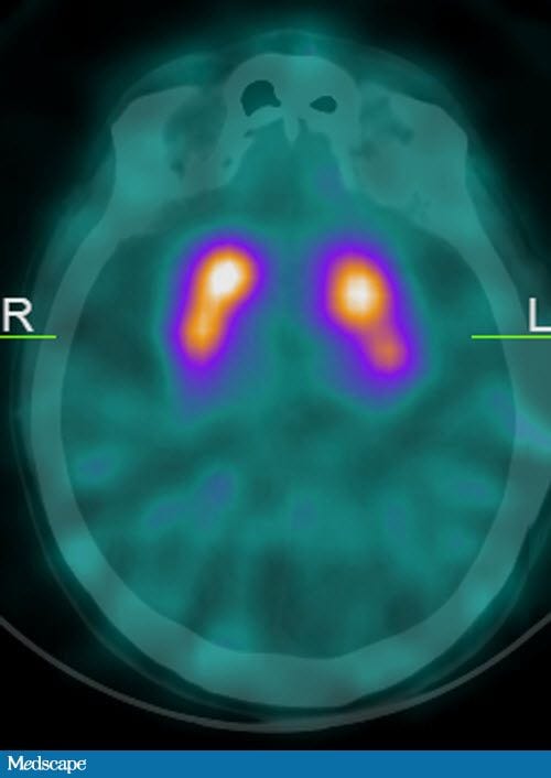 The Role Of Dopaminergic Imaging In Patients With Parkinsonism