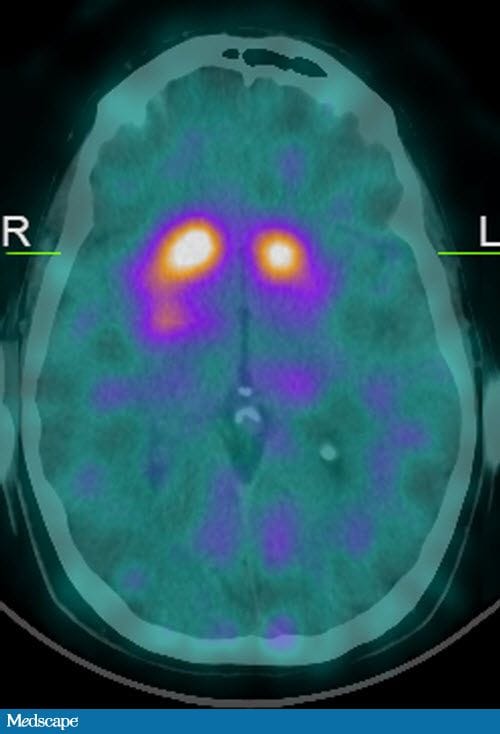 The Role of Dopaminergic Imaging in Patients With Parkinsonism