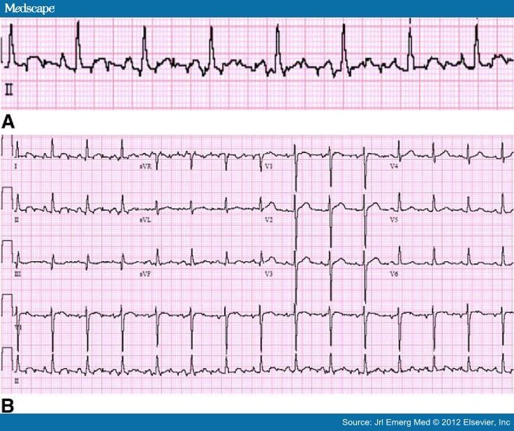 ECG Electrode Misplacement, Misconnection, and Artifact