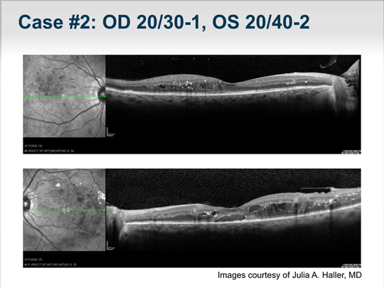 Advances in Diabetic Macular Edema: Improving Visual Outcomes (Transcript)