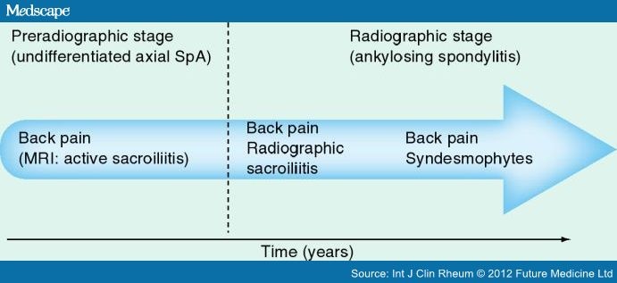 Asas Classification Criteria For Spondyloarthritis
