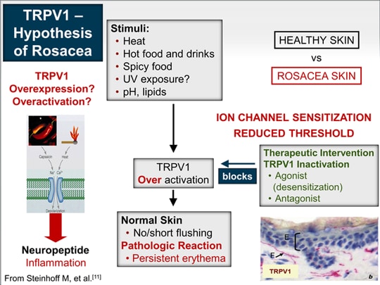 Pathophysiology And Treatment Of Erythema In Rosacea (Transcript)