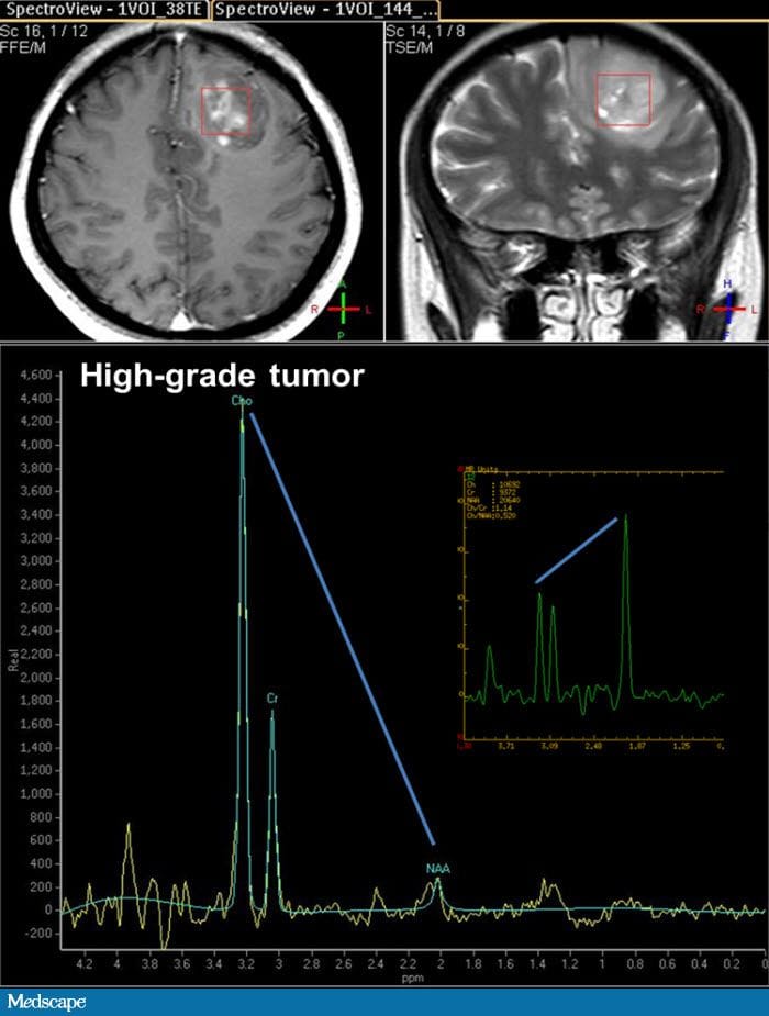 Role of Imaging in Brain Tumors