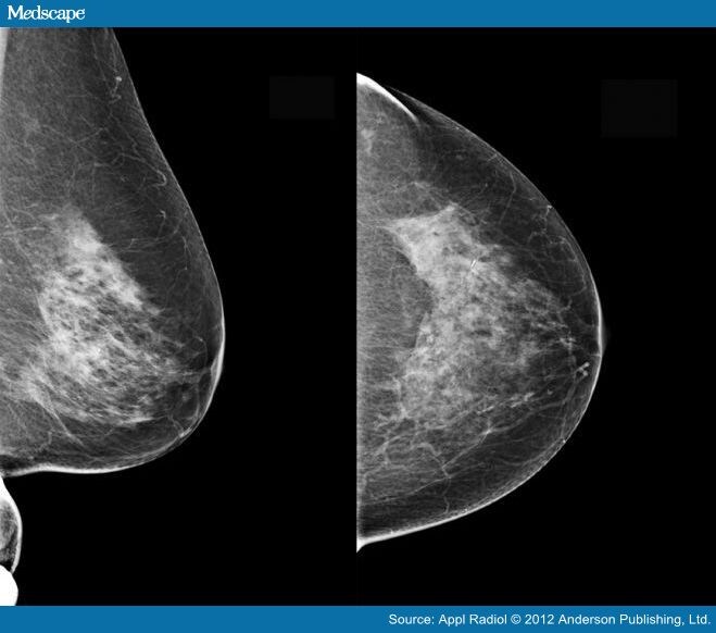 Breast Cancer Diagnosed by Tomosynthesis in Dense Breasts