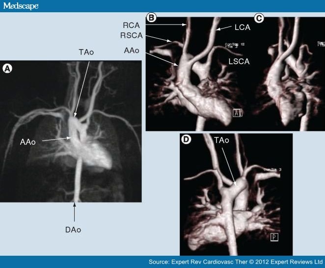 Imaging of Aortic Arch Anomalies and Associated Findings - Page 3