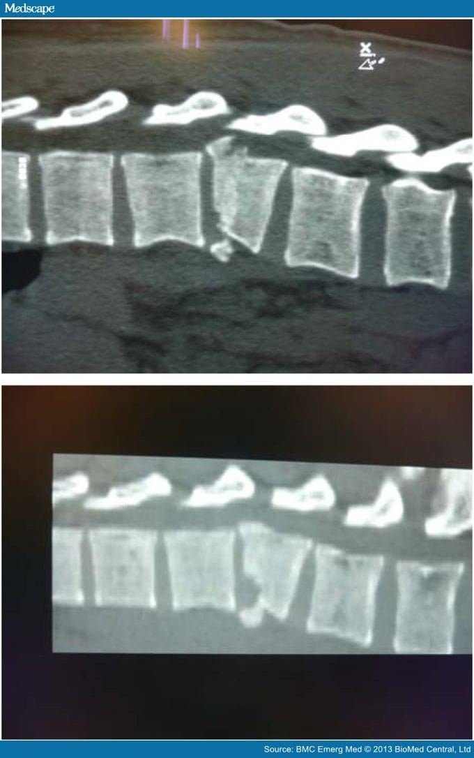 Identical Fracture Patterns in Combat Vehicle Blast Injuries - Page 3