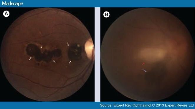 Ocular Complications of HIV/AIDS in the Era of HAART - Page 4