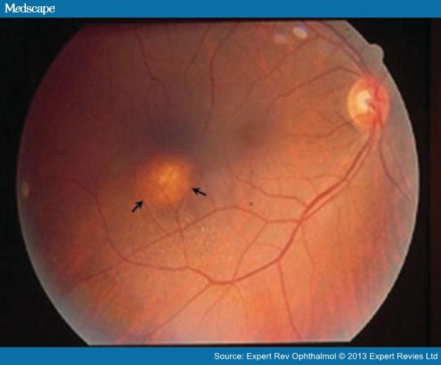 Ocular Complications of HIV/AIDS in the Era of HAART - Page 4