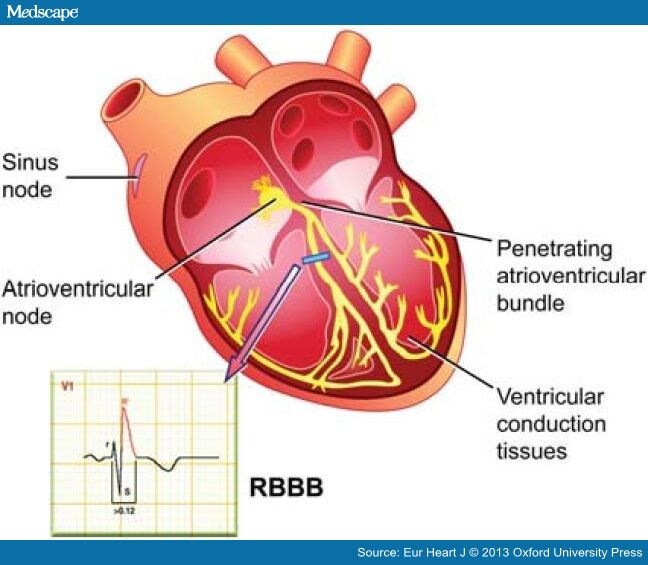 Right Bundle Branch Block