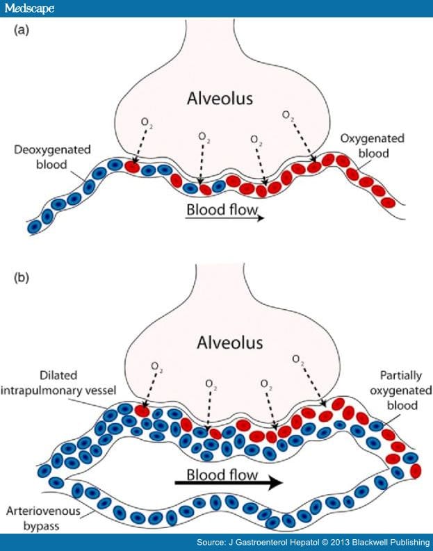 Hepatopulmonary Syndrome: Recent Advances in Treatment - Page 2