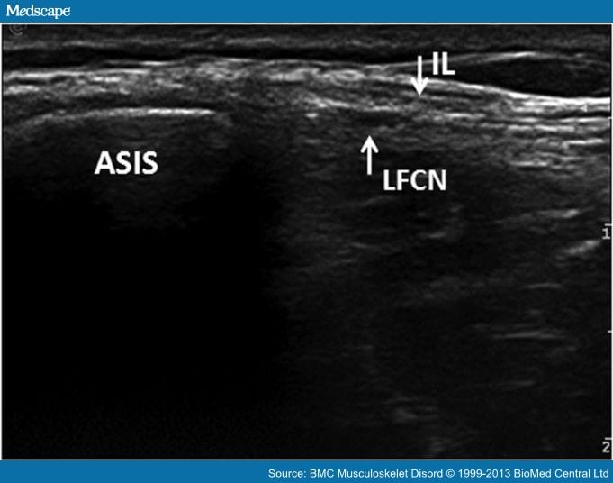 Ultrasound Of The Lateral Femoral Cutaneous Nerve In Adults