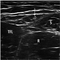 Ultrasound of the Lateral Femoral Cutaneous Nerve in Adults - Page 3