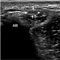 Ultrasound of the Lateral Femoral Cutaneous Nerve in Adults - Page 4