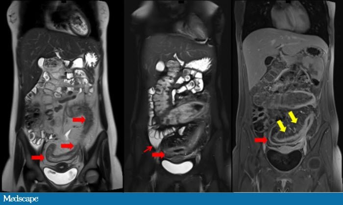 Imaging Ibd In Children