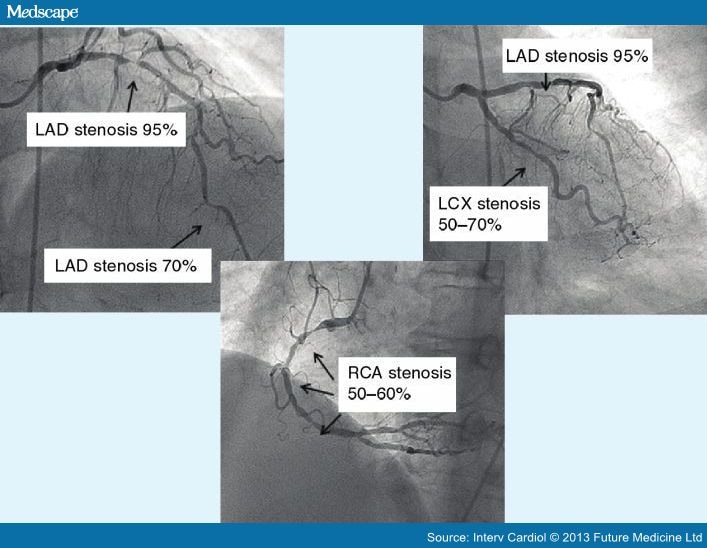 Coronary Bypass Surgery versus PCI