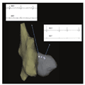 Current Role of Atrioventricular Junction (AVJ) Ablation - Page 4