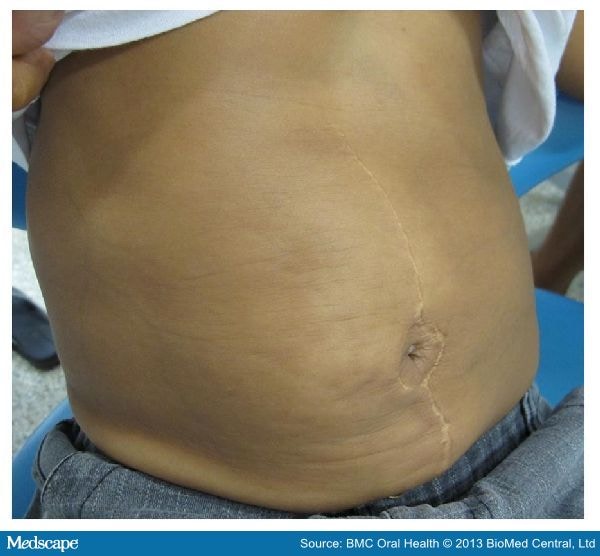 prune belly syndrome adults