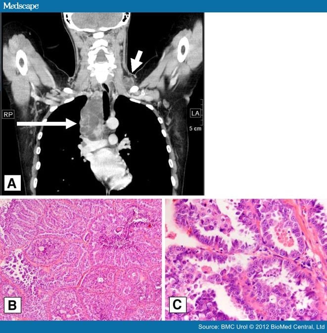 Renal Cell Carcinoma Diagnosed In A Cervical Lymph Node