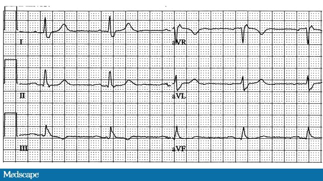 ivcd intraventricular conduction delay ivcd intraventricular conduction delay