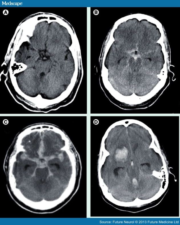 Update on the Management of Subarachnoid Hemorrhage