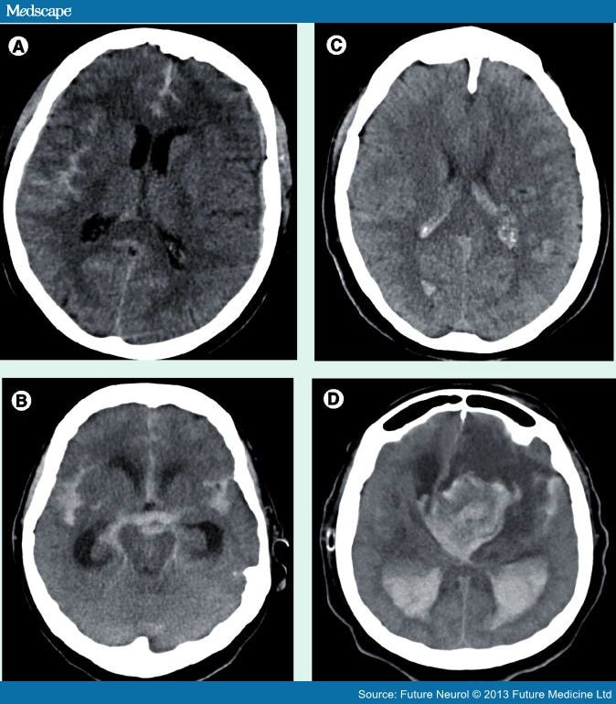 Update on the Management of Subarachnoid Hemorrhage - Page 2