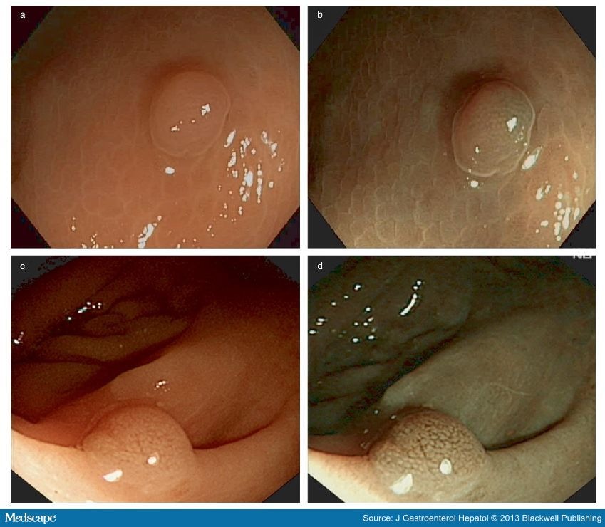 NBI vs White Light Endoscopy to Assess Colorectal Polyps