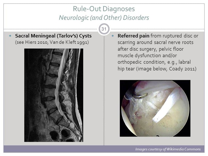 Vulvodynia An Underrecognized Pain Disorder Affecting 1 in 4 Women