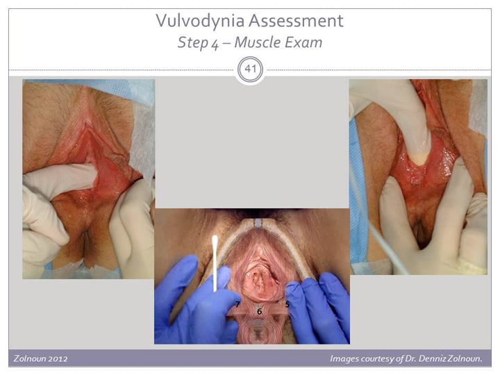 Vulvodynia: An Under-recognized Pain Disorder Affecting 1 in 4 Women and  Adolescent Girls – Integrating Current Knowledge Into Clinical Practice