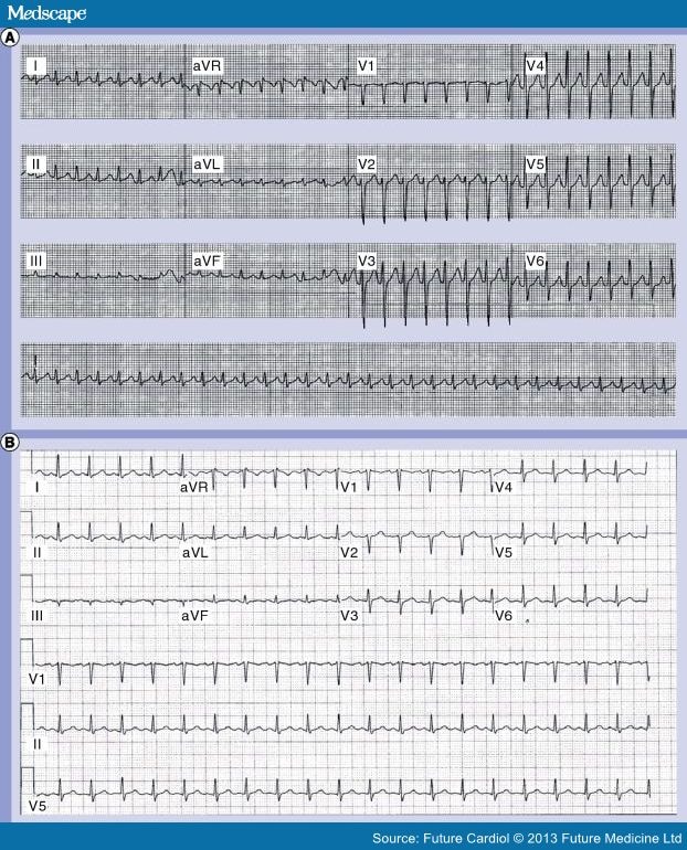 'Inappropriate' Sinus Tachycardia - Page 2