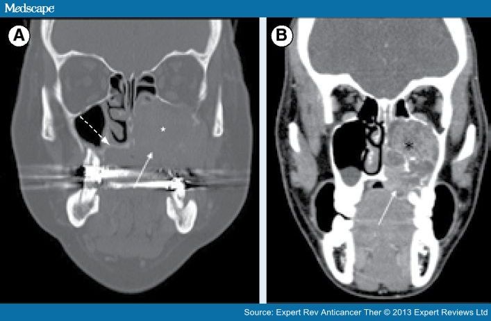 Imaging and Resectability Issues of Sinonasal Tumors