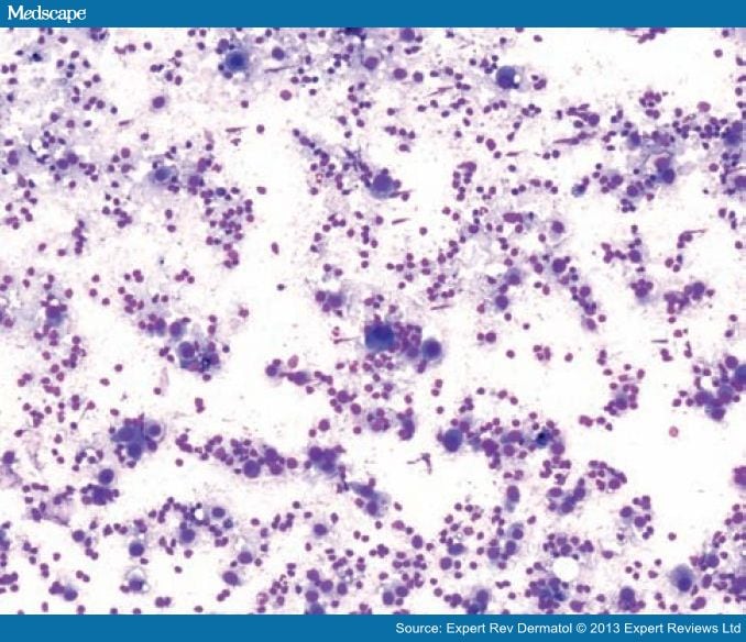 Ultrasound-Guided FNA Cytology of Lymph Nodes in Melanoma