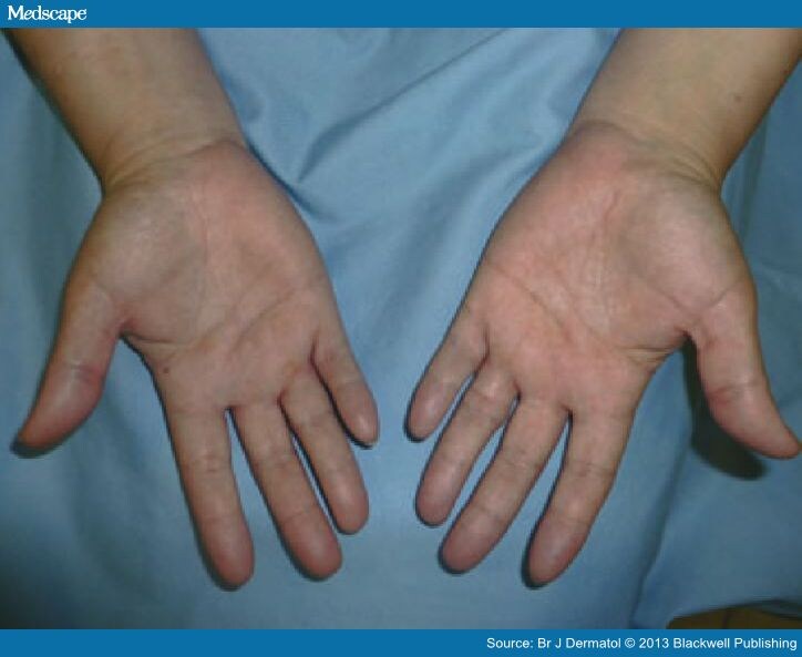 Ustekinumab in Refractory Palmoplantar Pustular Psoriasis