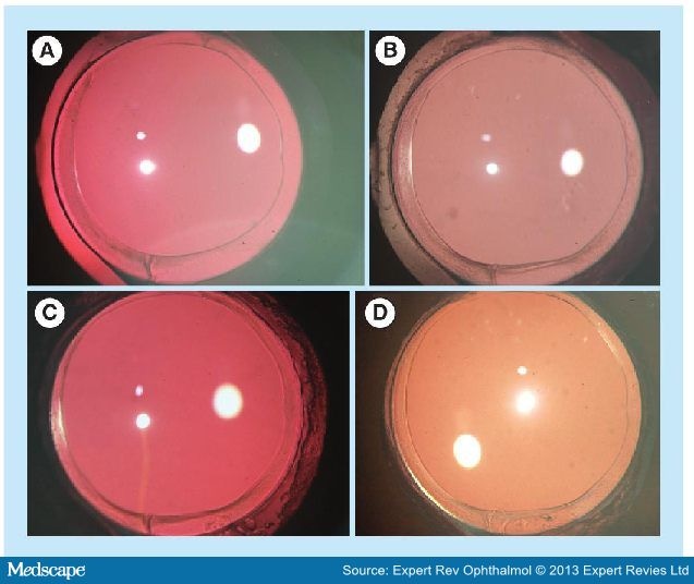 Posterior Capsule Opacification Fundoscopy at Henry Taylor blog