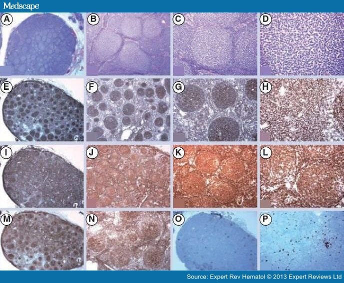 Atypical Lymphoid Proliferations