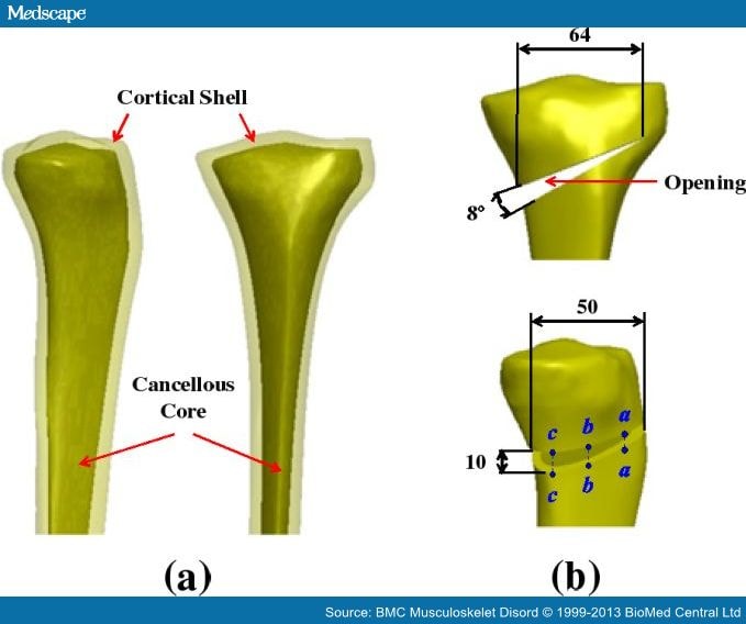 Comparing Different Systems For High Tibial Osteotomies - Page 3