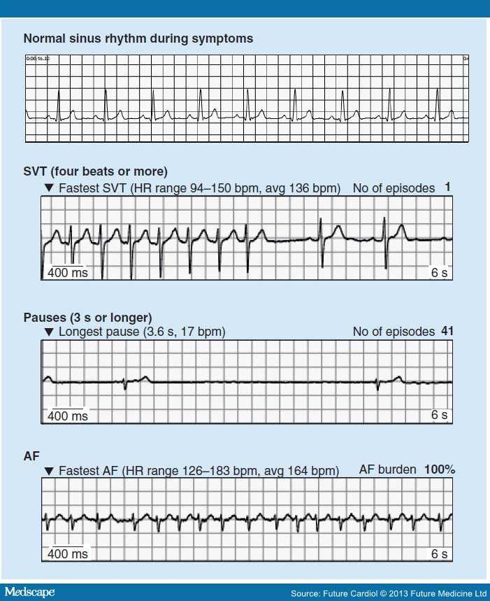 A Novel Patch for Heart Rhythm Monitoring - Page 2