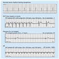 A Novel Patch for Heart Rhythm Monitoring - Page 2