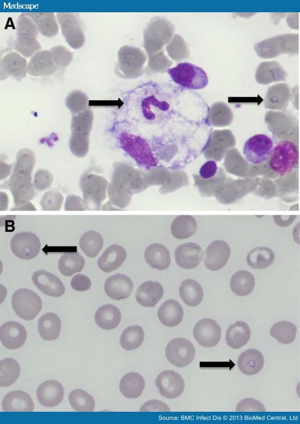 Babesia microti