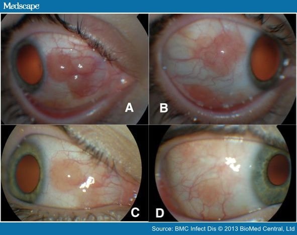 Poststreptococcal Syndrome Mimicking Conjunctival Lymphoma - Page 3