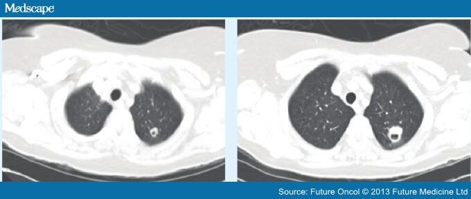 Evaluation and Management of Small Pulmonary Nodules