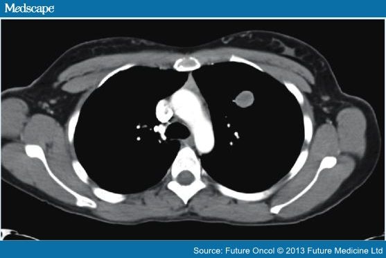 Evaluation And Management Of Small Pulmonary Nodules