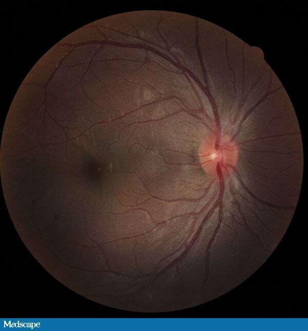 A 21YearOld With Headache and Blurred Vision Page 3