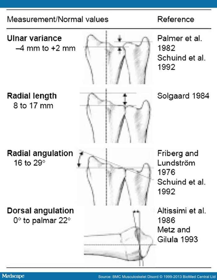 Dorsal Angulation Distal Radius Fracture - vrogue.co