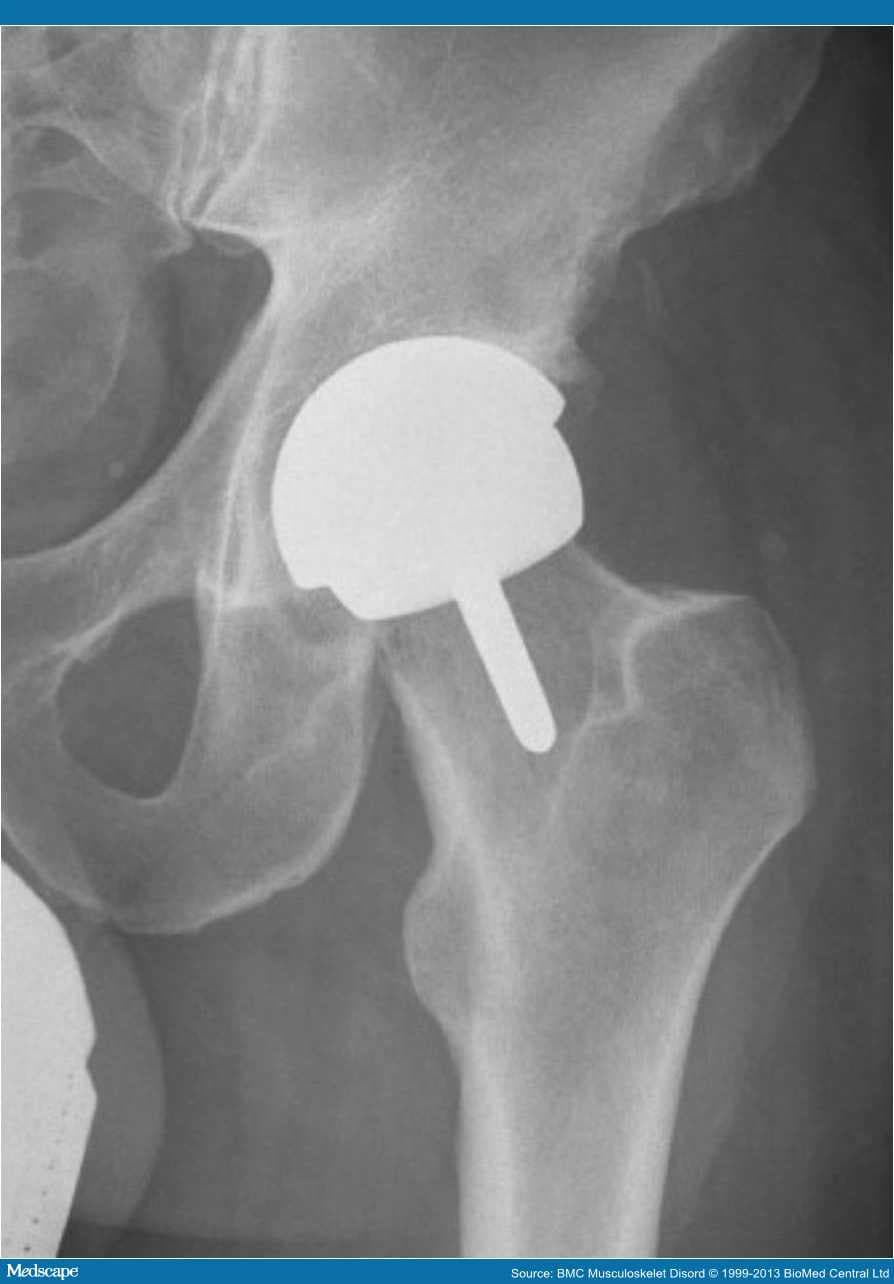 Outcomes of Hip Resurfacing vs Standard Primary THA in Men - Page 3