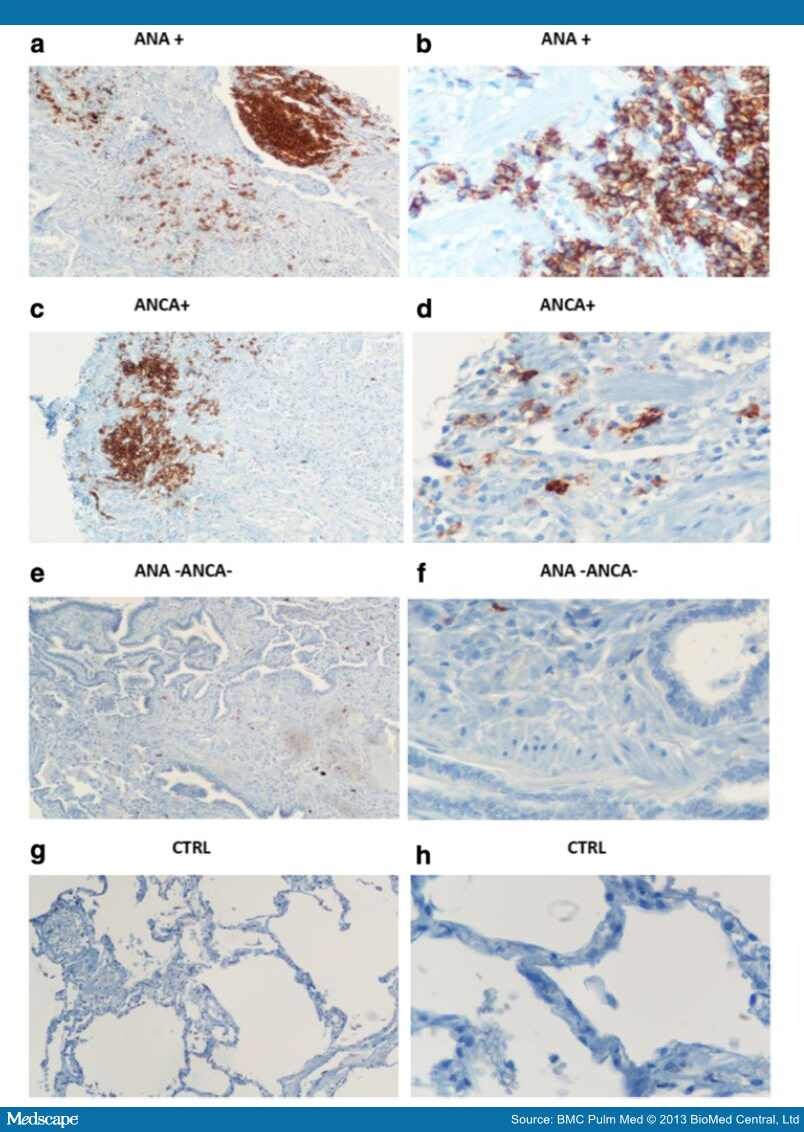 Autoimmune Markers in Pulmonary Fibrosis and Emphysema