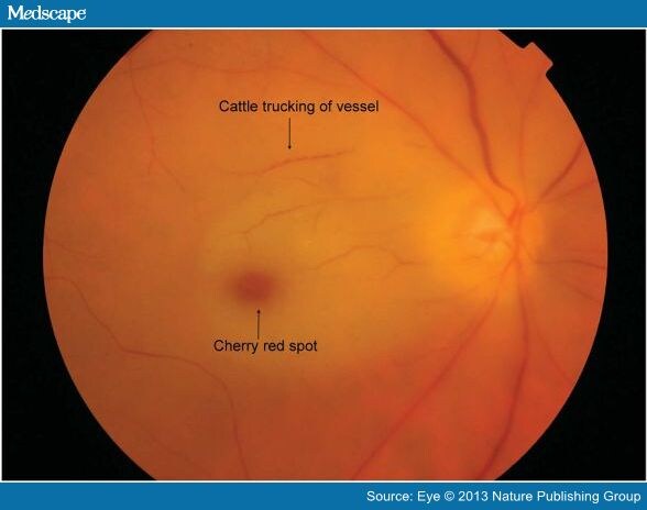 A Review of Central Retinal Artery Occlusion